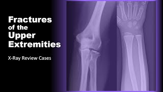 Fractures of the Upper Extremities on XRay radiology xray doctor [upl. by Eeroc]