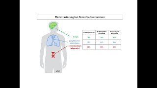 Metastasierung bei Bronchialkarzinomen  Strahlentherapie Prof Hilke Vorwerk [upl. by Ecirtac]