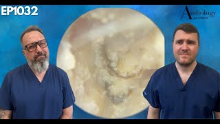 Removing a FUNGAL INFECTION from someones EAR CANAL  EP1032 [upl. by Martella]