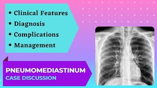 Case Presentation  Acute Chest Pain  Pneumomediastinum [upl. by Cami778]