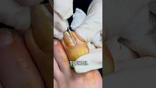 Curved Ingrown Toenail Fix by Dr Nick Campitelli Quick amp Painless Procedure [upl. by Inalawi]