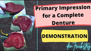 Primary Impression for a Complete Denture  Demonstration Super Simple [upl. by Nnyluqcaj]