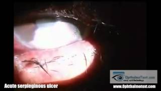 hypopyon corneal ulcer Acute serpieginous ulcer [upl. by Annaoj]