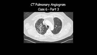 CT Pulmonary Angiogram  Case 6 Part 3 radiologist radiology angiogram pathological [upl. by Safier]