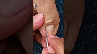 Satisfying Toe Cleaning  Relaxing Foot Care amp Deep Clean ASMR 23 [upl. by Muller445]