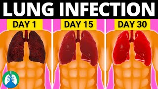 Top 10 Natural Lung Infection Treatments Home Remedies [upl. by Gillett]