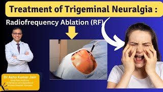 Relief from Trigeminal Neuralgia Effective Treatment with Radiofrequency Ablation [upl. by Sadowski90]