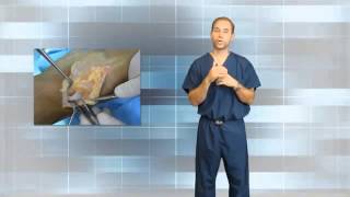 What is a Ganglion Cyst A Tennessee Podiatrist Explains [upl. by Brew]