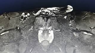 Osteitis pubis  MRI findings [upl. by Akinehs]