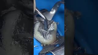 Silver Filling Amalgam amalgamfilling advanceddentistry silverfilling [upl. by Attekal]