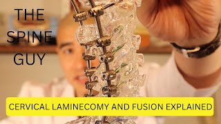 Cervical Laminectomy and Fusion Explained [upl. by Eagle]