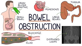 Understanding Bowel Obstruction [upl. by Debby528]