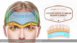 Brow Lift 101  Differences between brow lifting techniques  Part II  Aesthetic Minutes Browlift [upl. by Aicrag]