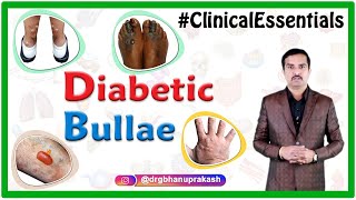 Diabetic bullae Bullosis Diabeticorum  Clinical essentials [upl. by Holzman]