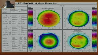 AIOC2018  GP062  Topic  Corneal topography How to read amp interpret [upl. by Fabe]