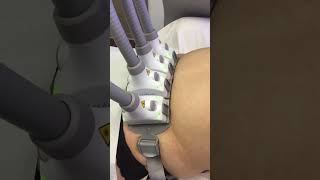 SculpSure Treatment at YPS sculpsure [upl. by Davita]