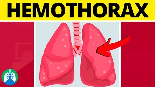 Hemothorax Medical Definition  Quick Explainer Video [upl. by Ahsener370]