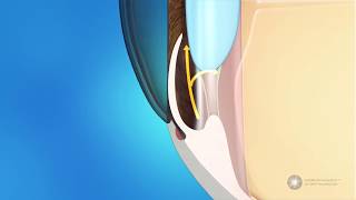 What is angleclosure glaucoma [upl. by Gaudet197]