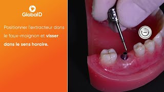 Comment extraire un fauxmoignon sur implant InKone® plateforme ST [upl. by Uok]