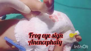 Frog eye sign in Anencephaly Incomplete skullUnderdeveloped brain [upl. by Kristy]