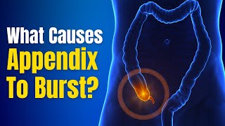 Appendicitis What are the signs causes and how to treat it  Acute Appendicitis  The Healthsite [upl. by Aiciram]