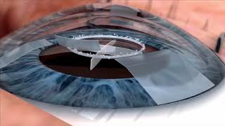 Watch live surgery using the laser cataract system  how does it work Eye News TV [upl. by Chelsey]