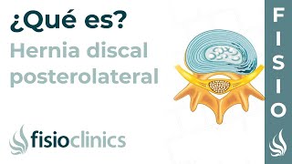 Protrusión o hernia discal posterolateral o posteromedial ¿Qué es  FisioClinics Palma de Mallorca [upl. by Niltyak]