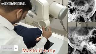 mastoid xray position in Urdu Hindidoctor physiotherapy mbbs [upl. by Naesal]