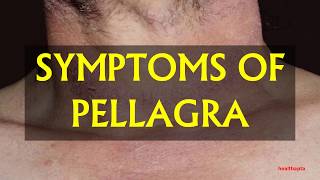 SYMPTOMS OF PELLAGRA [upl. by Nide]