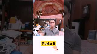 Tratamiento de los torus mandibulares odontologia dentista torus shorts [upl. by Aelhsa]