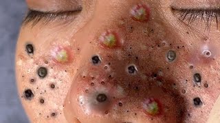 Amazing Blackhead remover remove blackheads blackheads [upl. by Jarrid821]