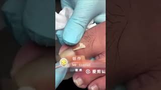 Ingrown toenail removal with Pedicure Knife Cut it easily Ep474 [upl. by Range]