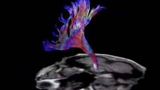 Brain Fiber Tractography [upl. by Gabriela]