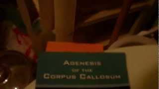 a good ACC book for those with agenesis of the corpus callosum [upl. by Asilat985]