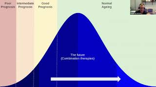 Making the case for flipping the pyramid to treat MS [upl. by Machos]