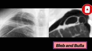 Blebs and Bullae radiology thoracicsurgery pulmonology [upl. by Llenet]