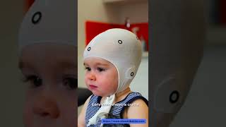 Infant Deformed Head Shaping Helmet Plagiocephaly Therapy UK [upl. by Noyad]