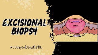 EXCISIONAL BIOPSY  30daysofOSwithDME [upl. by Darn]