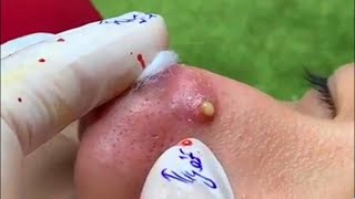 Big Cystic Acne Blackheads Extraction Blackheads amp Milia Whiteheads Removal Pimple Popping  4609 [upl. by Haym]