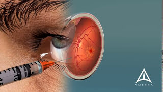 How Macular Degeneration Affects Your Vision  3D animation [upl. by Fenelia]