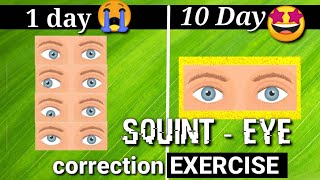 Squint Eye treatment NATURALLY with exercises at Home [upl. by Asiat]