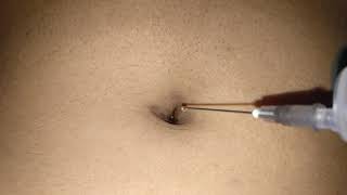 Navel injection [upl. by Curran]