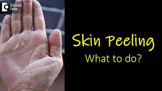 What causes skin peeling from fingers and feet How to manage  Dr Rasya Dixit [upl. by Aynekal753]