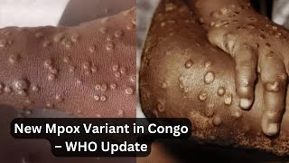 Mpox Cases Plateau in Congo Amid New Variant  WHO Update [upl. by Ainahpets]