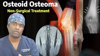 Live Osteoid Osteoma Treatment Without Surgery in India  RFA Laser Surgery for leg Osteoid Osteoma [upl. by Eelimaj]