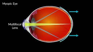 How Multifocal Contact Lenses Can Help Myopia [upl. by Ardnik]