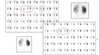 IAEAESNM Webinar  Cortical static renal scintigraphy and radionuclide cystographies [upl. by Alitha786]