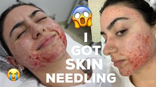 HOW I GOT RID OF MY ACNE SCARRING [upl. by Obeded]