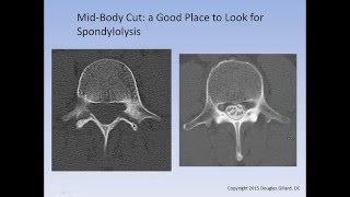 The Spondylolysis  Spondylolisthesis Lecture [upl. by Nodnerb]