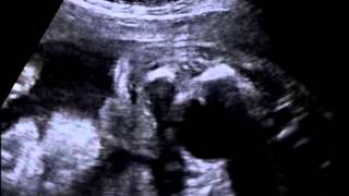 Realtime ultrasound of fetal diphallia Video 2 [upl. by Pellegrini]